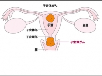 子宮に発生するがんは2つ。特に子宮頸がんは若い女性に多い